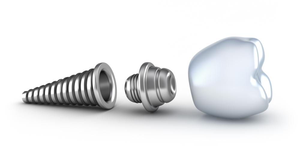 a diagram of a dental implant | dental implants evansville