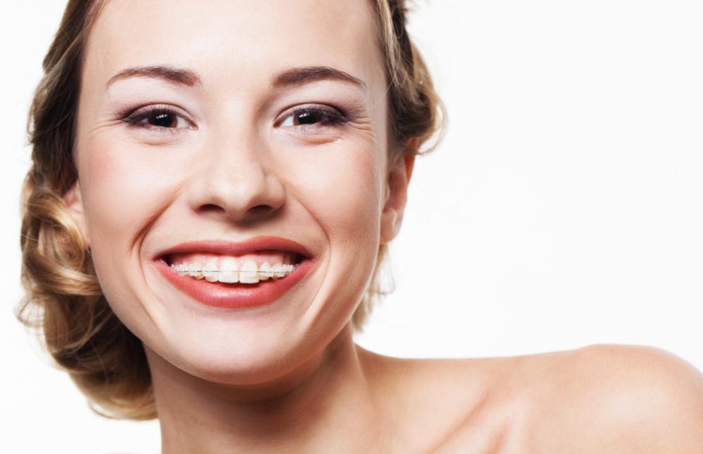 A Woman Smiles wearing braces | Evansville, IN Six Month Smiles