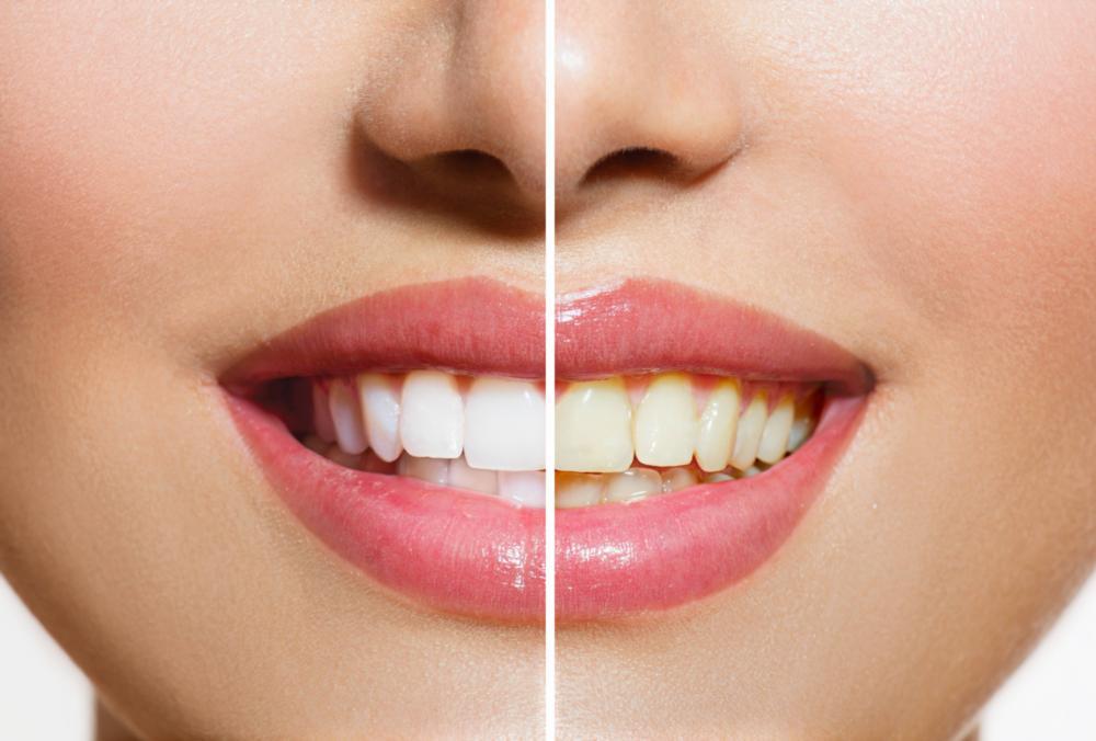 a before and after image of a smile that has been whitened | dentist Evansville IN