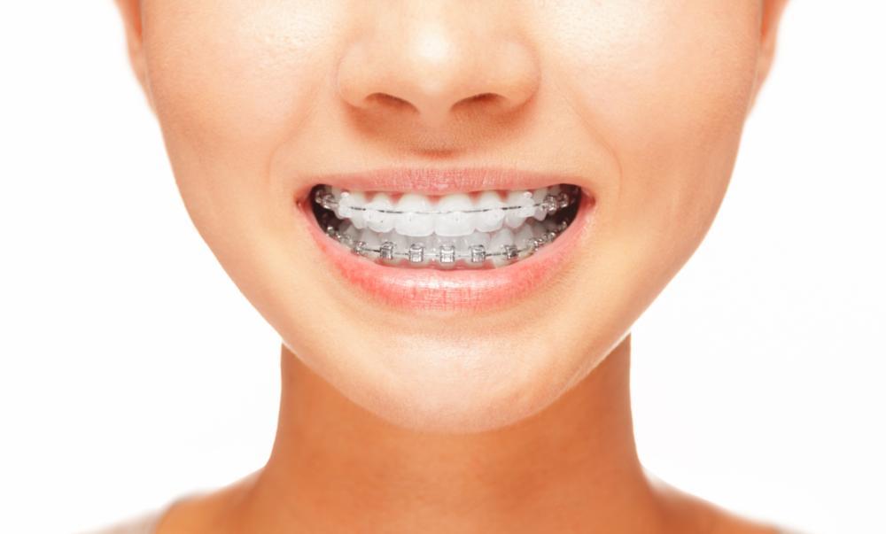 A woman with braces smiles | Six Month Smiles Evansville, IN