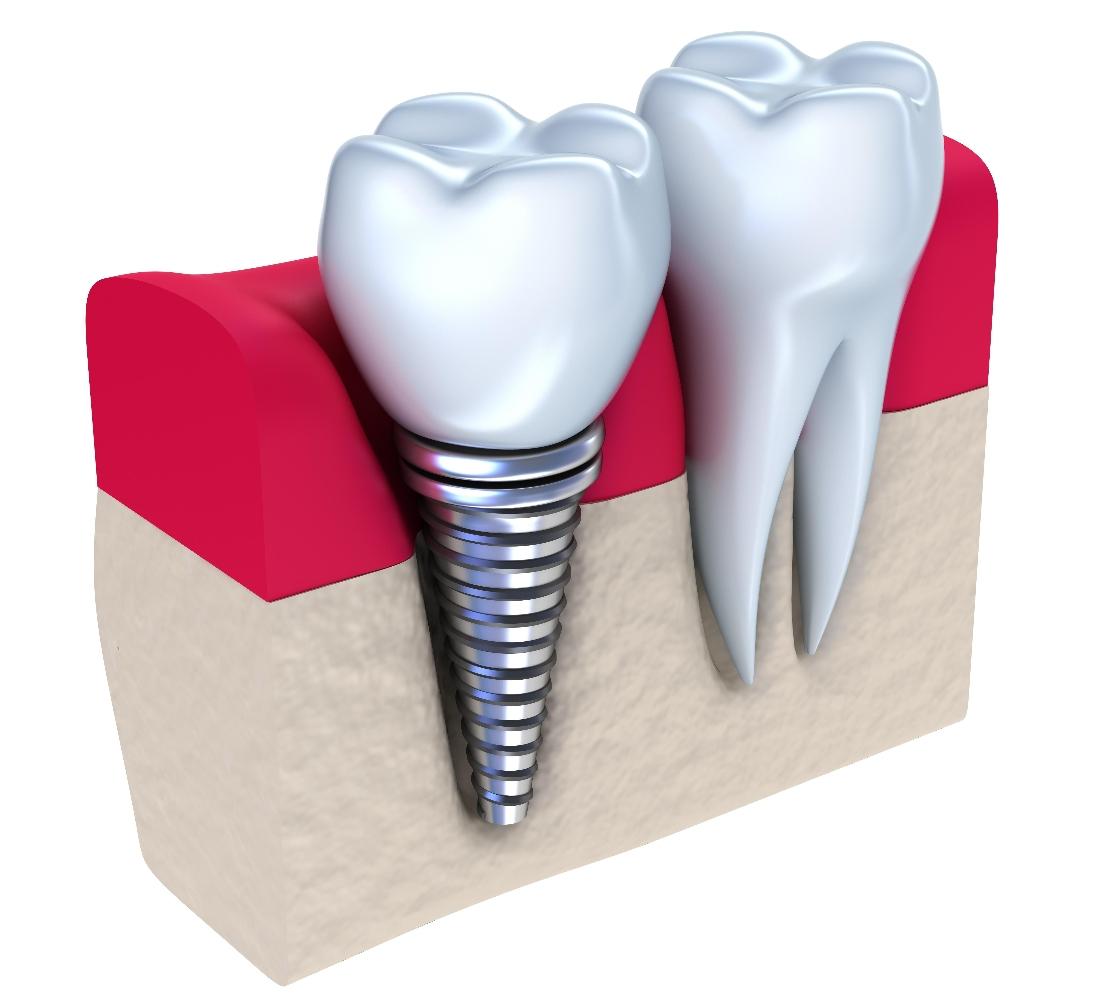Dental Implants Evansville Stages of Getting a Dental Implant