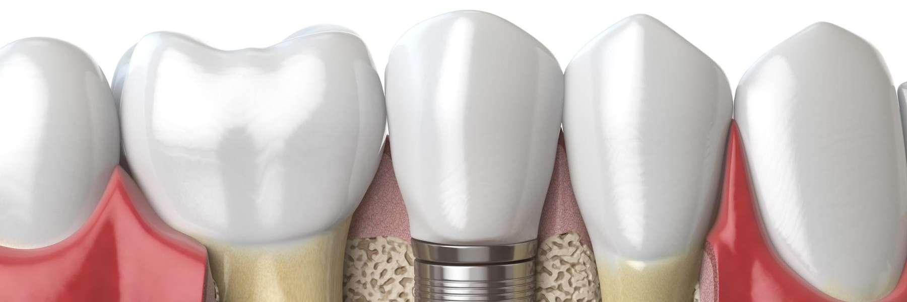 A detailed image of dental implants