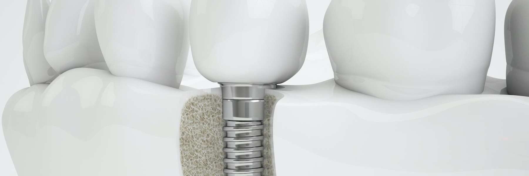 Lower jaw dental implant in Newburgh IN