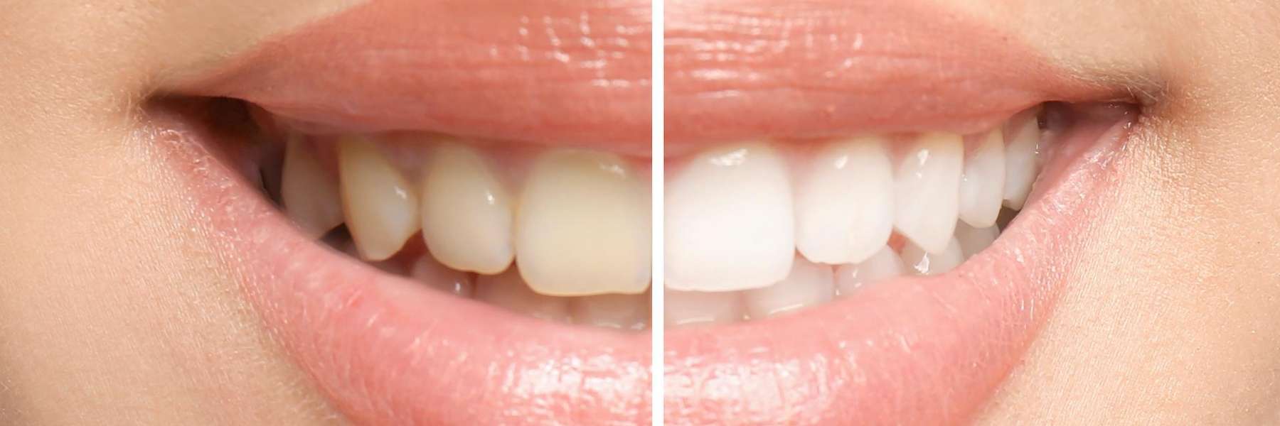 Teeth whitening before and after in Evansville TN