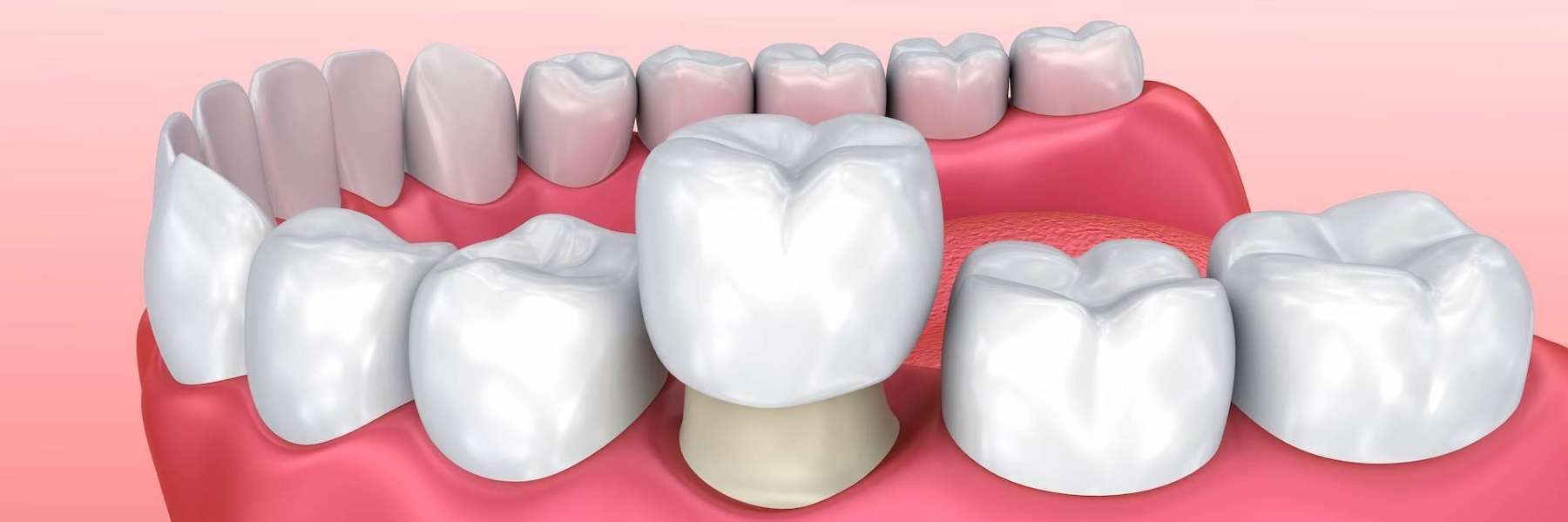 Dental implant crown post-root canal, sensitivity addressed via restoration