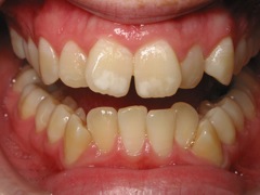 Close up of crooked front teeth | Before Braces