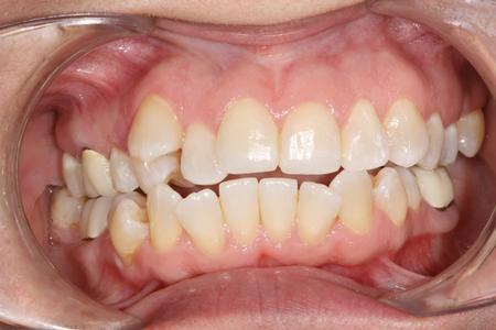Crowding on top teeth | Six Month Smiles