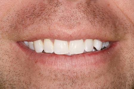 Close up of man's smile | Evansville IN Dentist