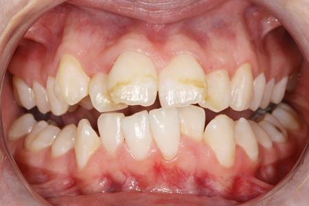 Crowded and crooked teeth | Evansville IN Dentist