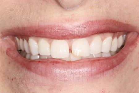 Gap between front teeth | Dentist Evansville IN