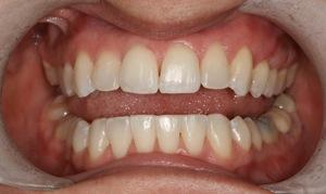 Teeth straightened from Six Month Smiles | Evansville IN Dentist