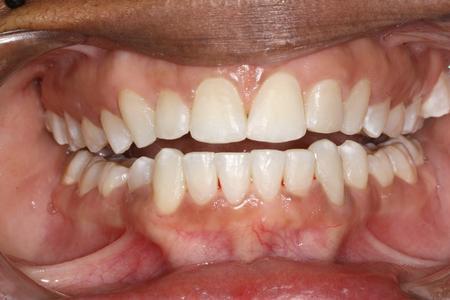 Teeth straightened by Six month smiles | Evansville IN Dentist