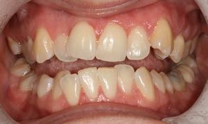 Crooked teeth | Dentist Evansville IN