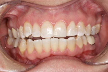 Straightened Teeth | Evansville IN Dentist