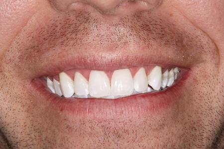 Close up of man's smile after whitening | Evansville IN Dentist