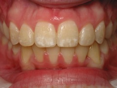Close up of straightened smile after Six Month Smiles