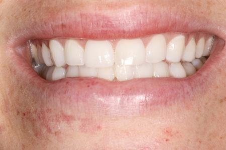 Resin Bonding used to fill gap | Evansville IN Dentist