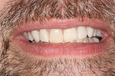 Whitened Front Teeth | Reliant Family Dental