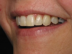 Straight Teeth After Six Month Smiles | Dentist Evansville IN