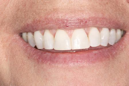 Woman's Smile After Six Month Smiles | Evansville IN Dentist