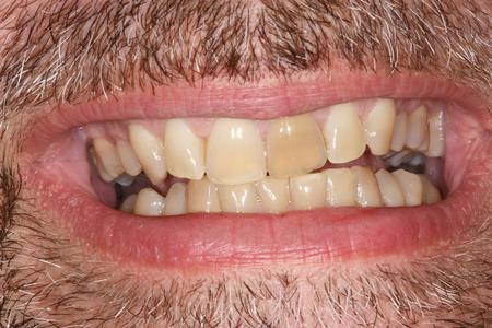 Deeply Stained Front Teeth | Evansville IN Dentist